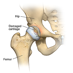 Hip Replacement Surgery in Nagpur