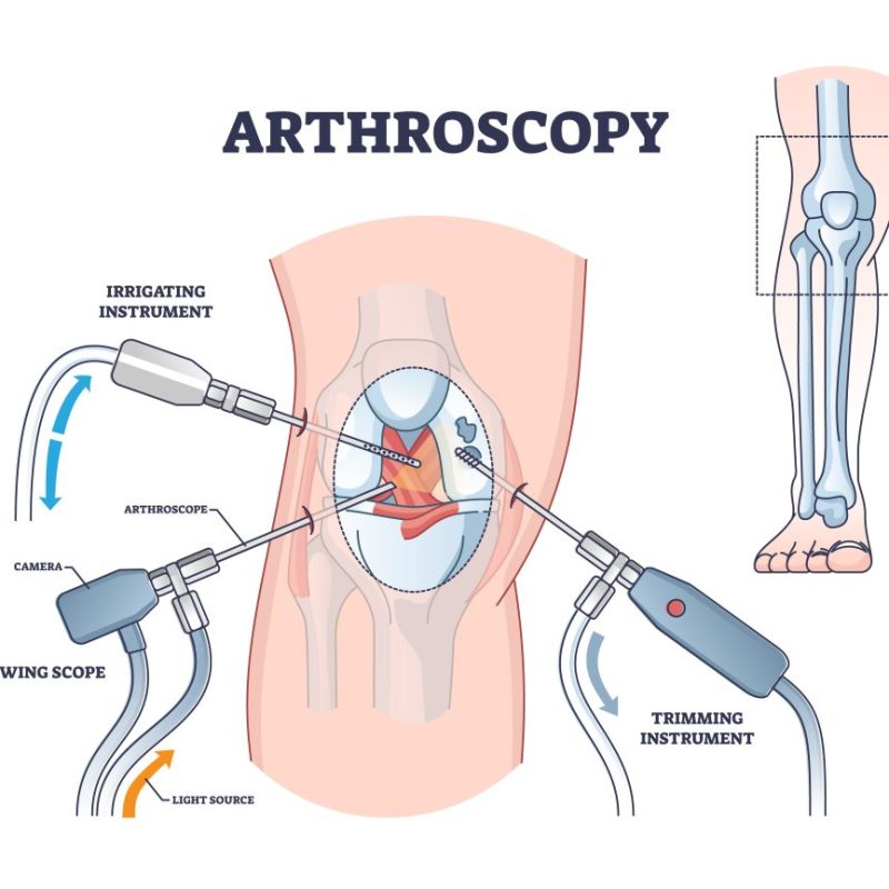 arthroscopy surgery in nagpur