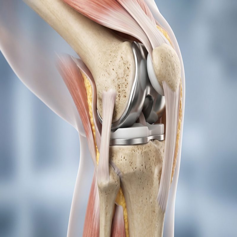 knee replacement surgery in nagpur copy
